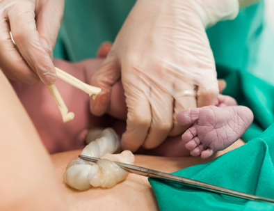 newborn umbilical cord being clamped